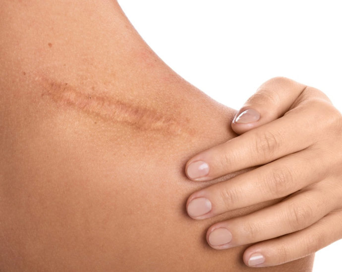 Woman's scar prevention treatment